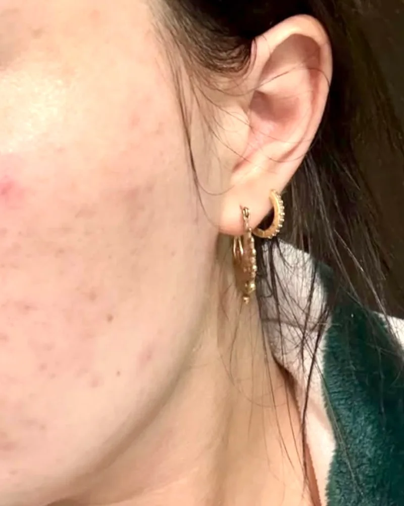 Customer photo of her cheek after using Serene Green Face Balm