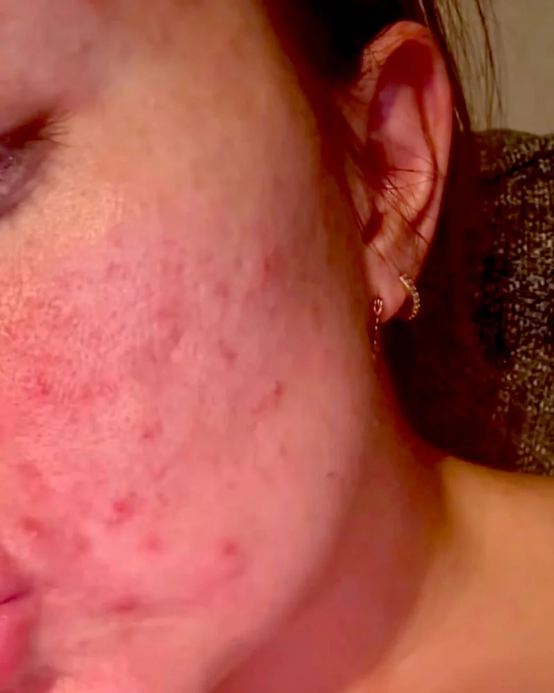 Customer photo of her cheek before using Serene Green Face Balm