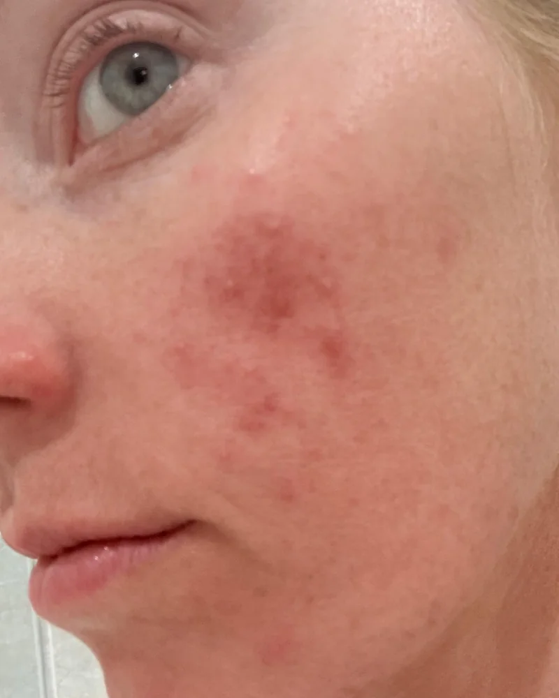 Customer photo of her cheek before using the tallow face and body balm