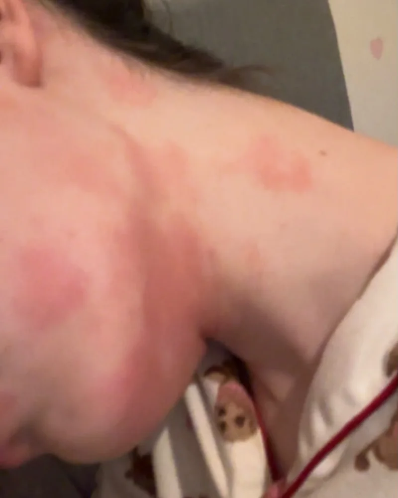 Customer photo of her neck before using the tallow face and body balm